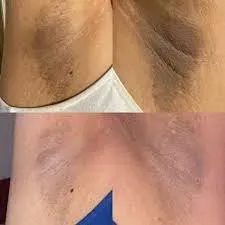 UNDERARMS WHITENING  service image