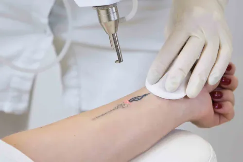 TATTOO REMOVAL  service image