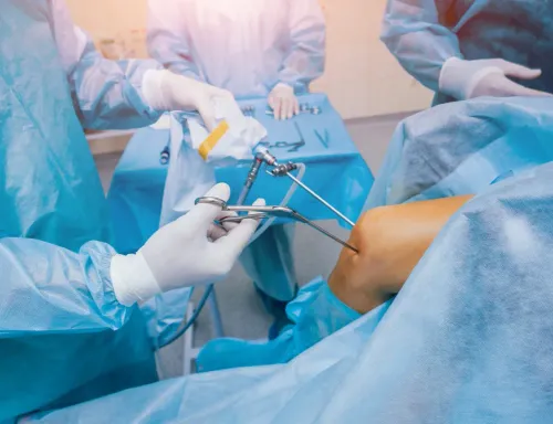 ACL Reconstruction Surgery service image