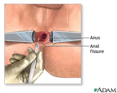 Fissurectomy for Anal Fissure  service image