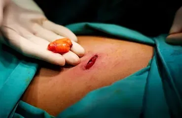 Lipoma Surgery service image