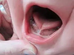 Tongue Tie service image