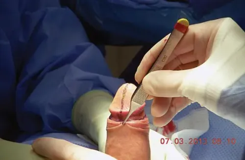 Circumcision Surgery   service image