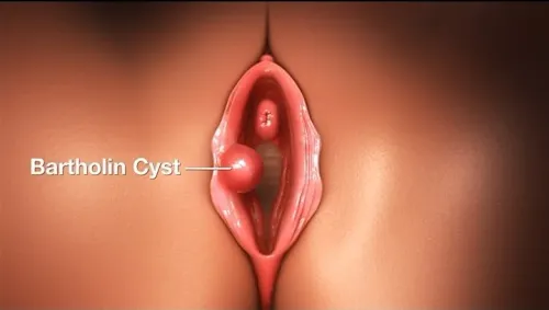 Bartholin's Cyst Surgery service image