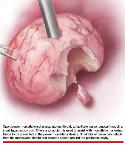 Myomectomy with Morcellation service image
