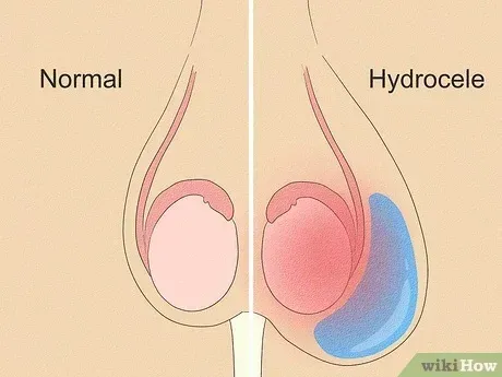 Hydrocele Surgery  service image