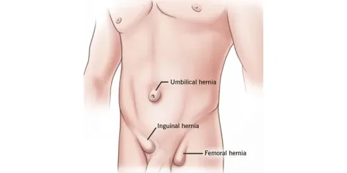 Hernia Surgery  service image