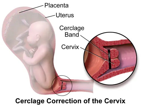 Cervical Cerclage in Pregnancy  service image