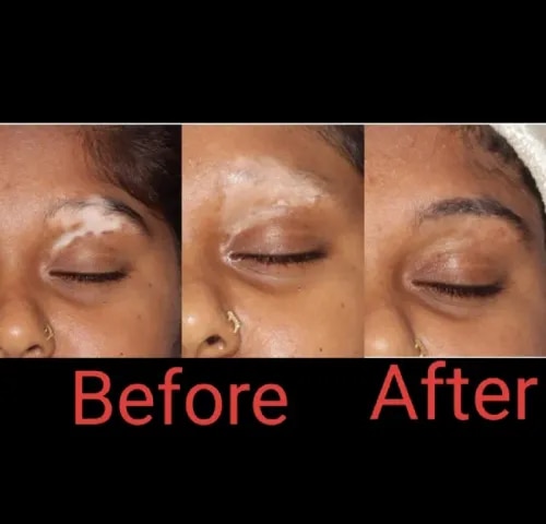 PRP THERAPY For VITILIGO(WHITE PATCHES ) service image