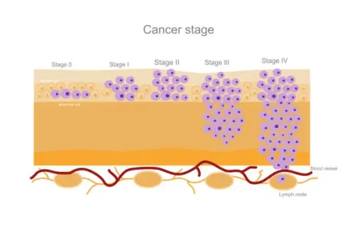 Staging of cancer service image