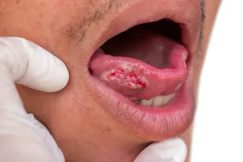 Oral cancer treatment service image