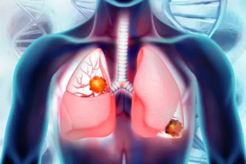 Lung cancer treatment service image