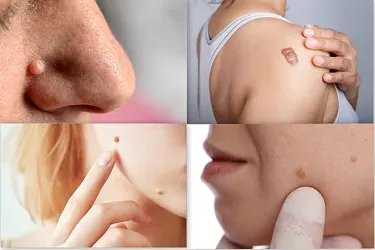 Moles / Warts / Keloids / Skin Tags service image