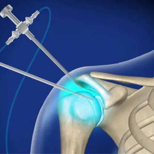 Shoulder Arthroscopy Treatment service image