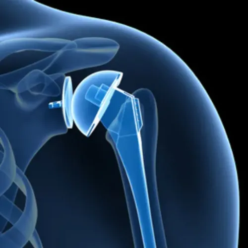 Shoulder Replacement Treatment service image