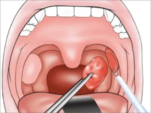 Coblation Assisted Tonsil and Adenoid Surgeries service image