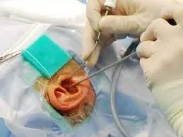 Ear Surgeries (Microscopic and Endoscopic) service image