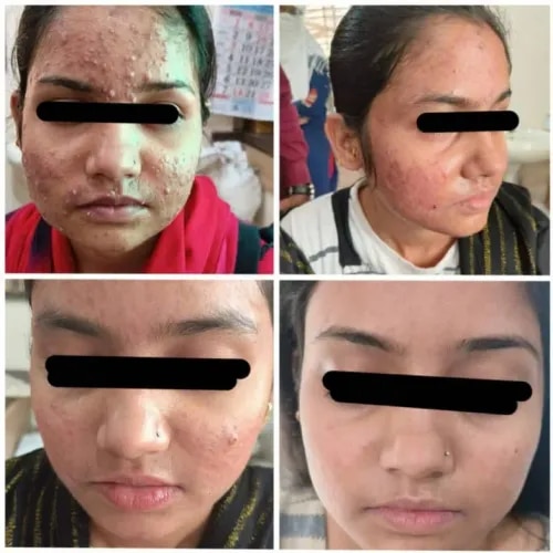 Chemical Peeling service image