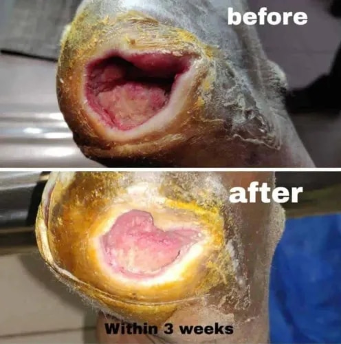 PRP THERAPY For Non Healings Wounds  service image