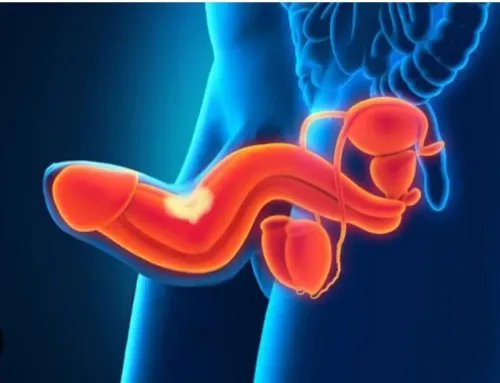 Peyronies Disease service image