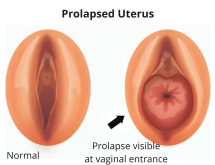 Prolapse of Uterus service image