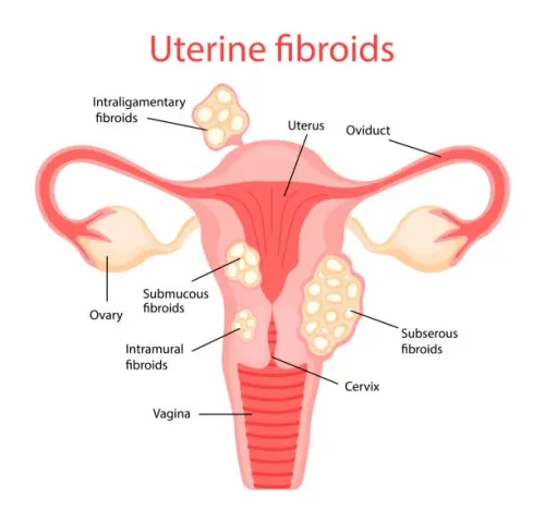Uterine Fibroids service image
