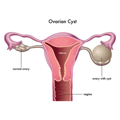 Ovarian Cyst service image