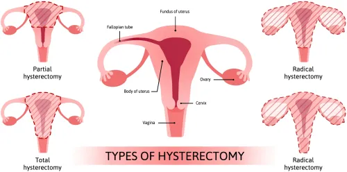 Hysterectomy service image