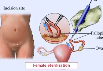 Sterilisation and Tubal Ligation service image