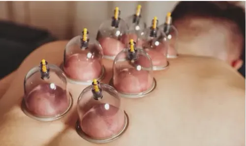 Cupping Therapy in Ayurveda service image