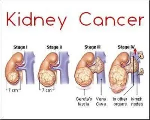 Kidney Cancer surgery and treatment service image