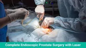 LASER & COMPLETE ENDOSCOPIC TREATMENT OF BLADDER STONES service image