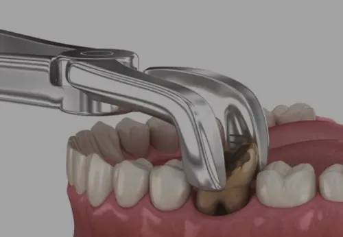 Dental Surgical Extraction service image