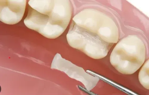 Cosmetics Restoration / Fillings  service image