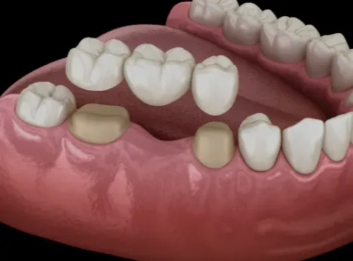 Ceramic crown & Bridge service image
