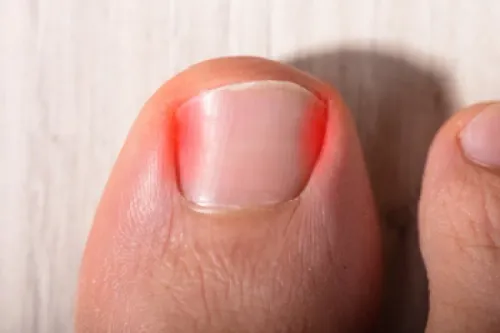 NAIL AVULSION service image