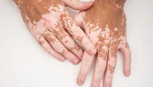 VITILIGO SURGERY service image