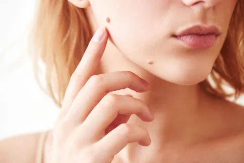 MOLE REMOVAL service image