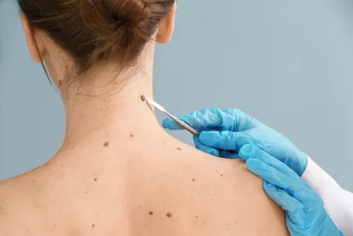 WART REMOVAL service image