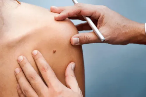 SKIN TAGS REMOVAL service image