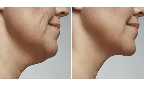 JAW LINE CORRECTION service image