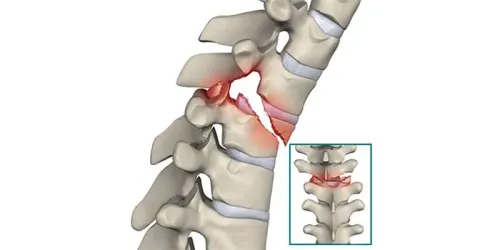 Spine Fracture Treatment in Pune service image