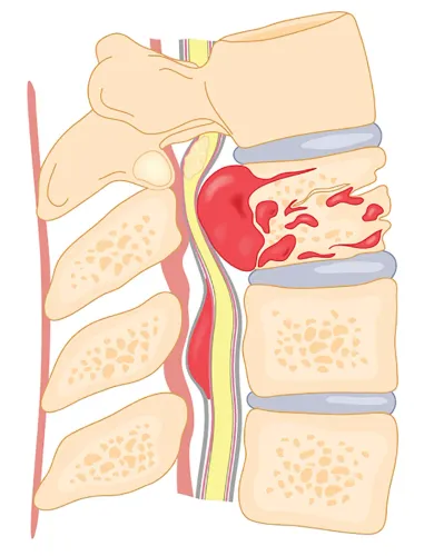 Spine Tumor Treatment in Pune service image