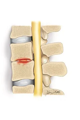 Spine Infection Treatment in Pune service image