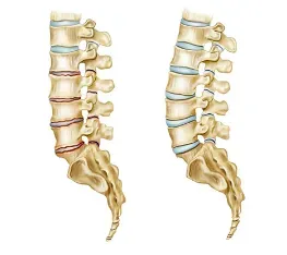 Lumbar Spine Disorder Treatment in Pune service image