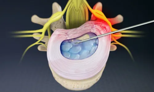 Microdiscetomy Surgery Specialist in Pune service image