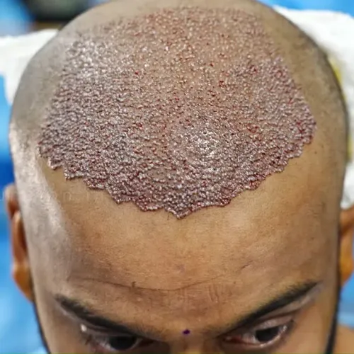 FUE Hair Transplant in Thane service image