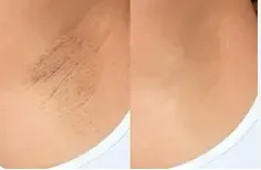UNDERARM PEEL service image