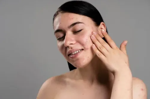 ACNE SCAR PEEL service image