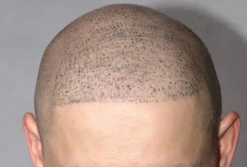 SCALP MICROPIGMENTATION service image